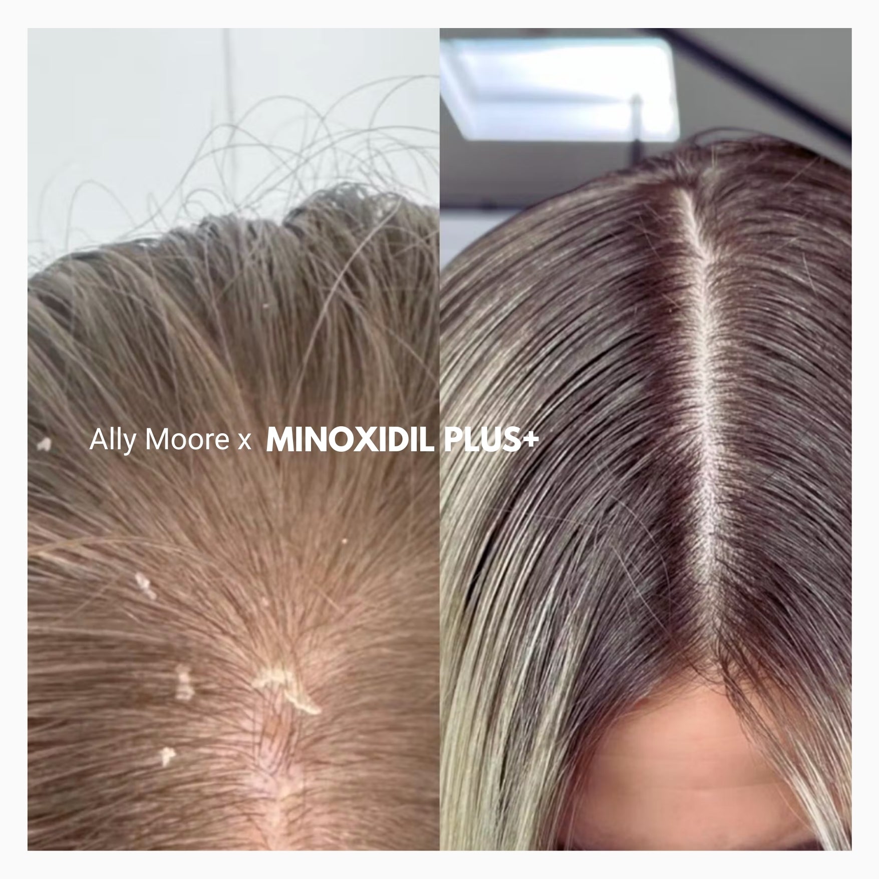 alcohol free propylene glycol free minoxidil
