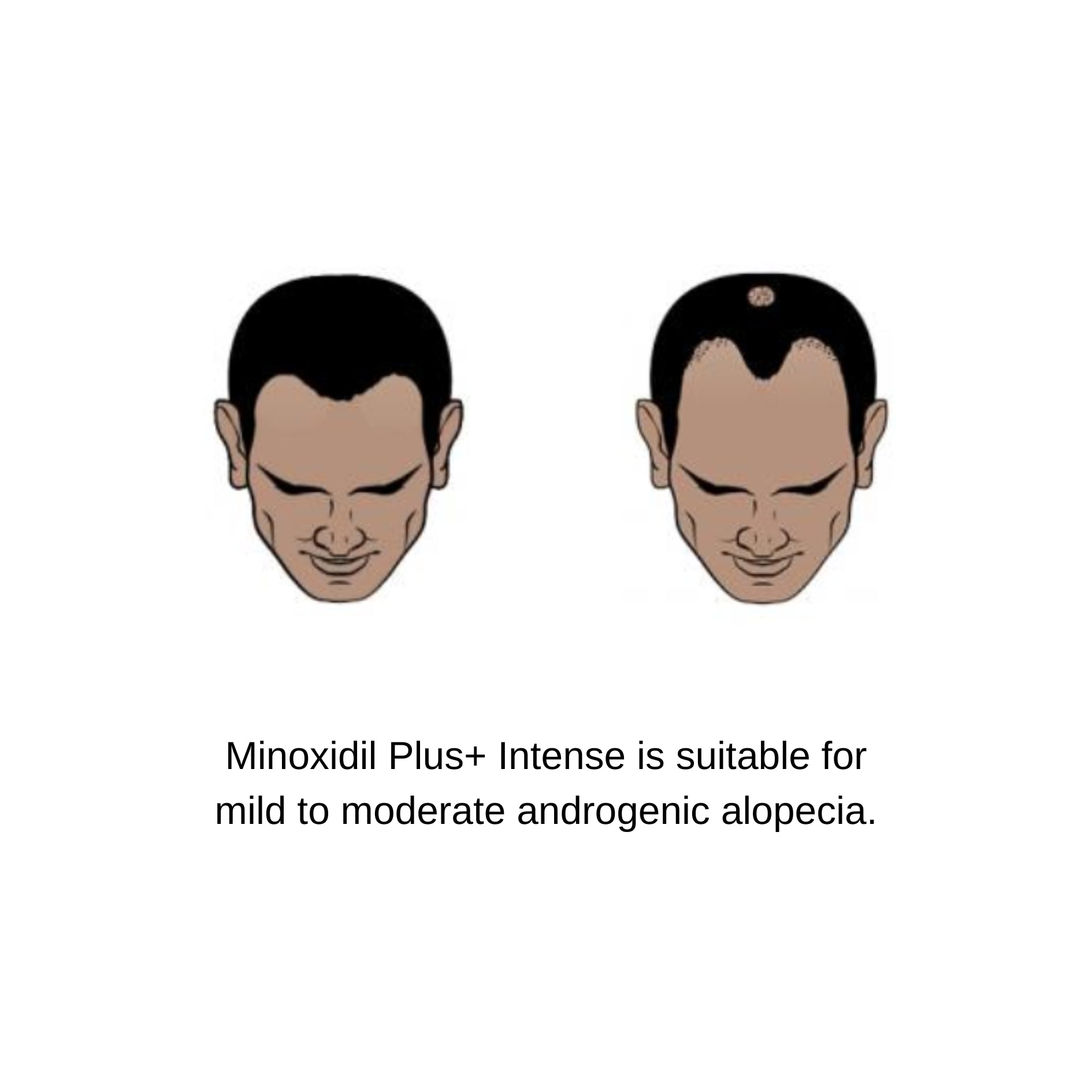Minoxidil Plus+ Intense (low alcohol)