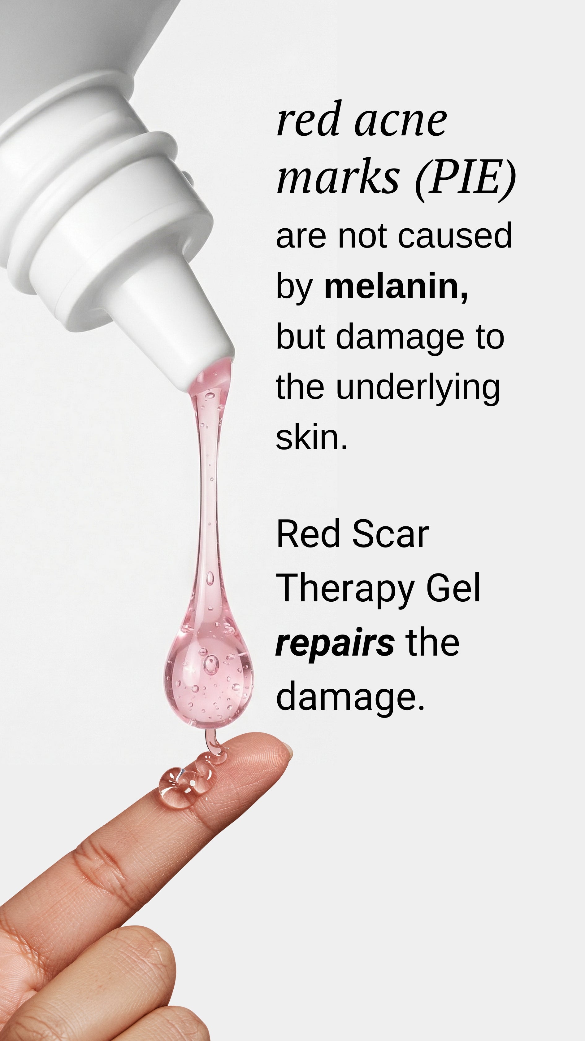 how to remove red acne marks