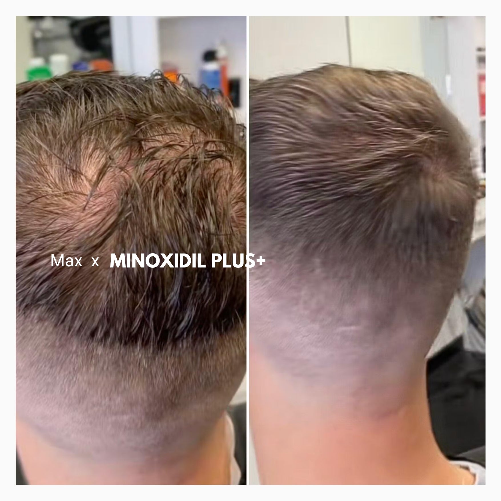 alcohol free propylene glycol free minoxidil