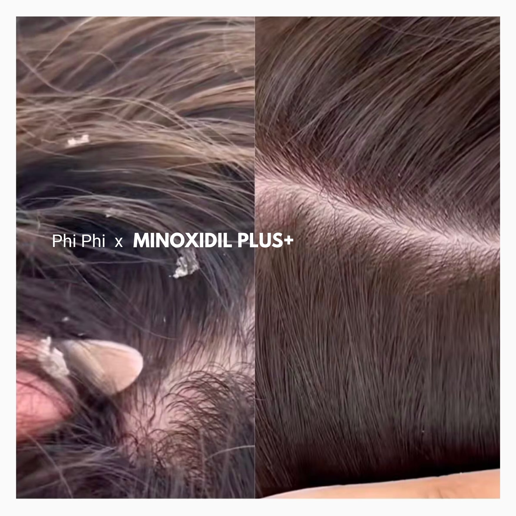 alcohol free propylene glycol free minoxidil