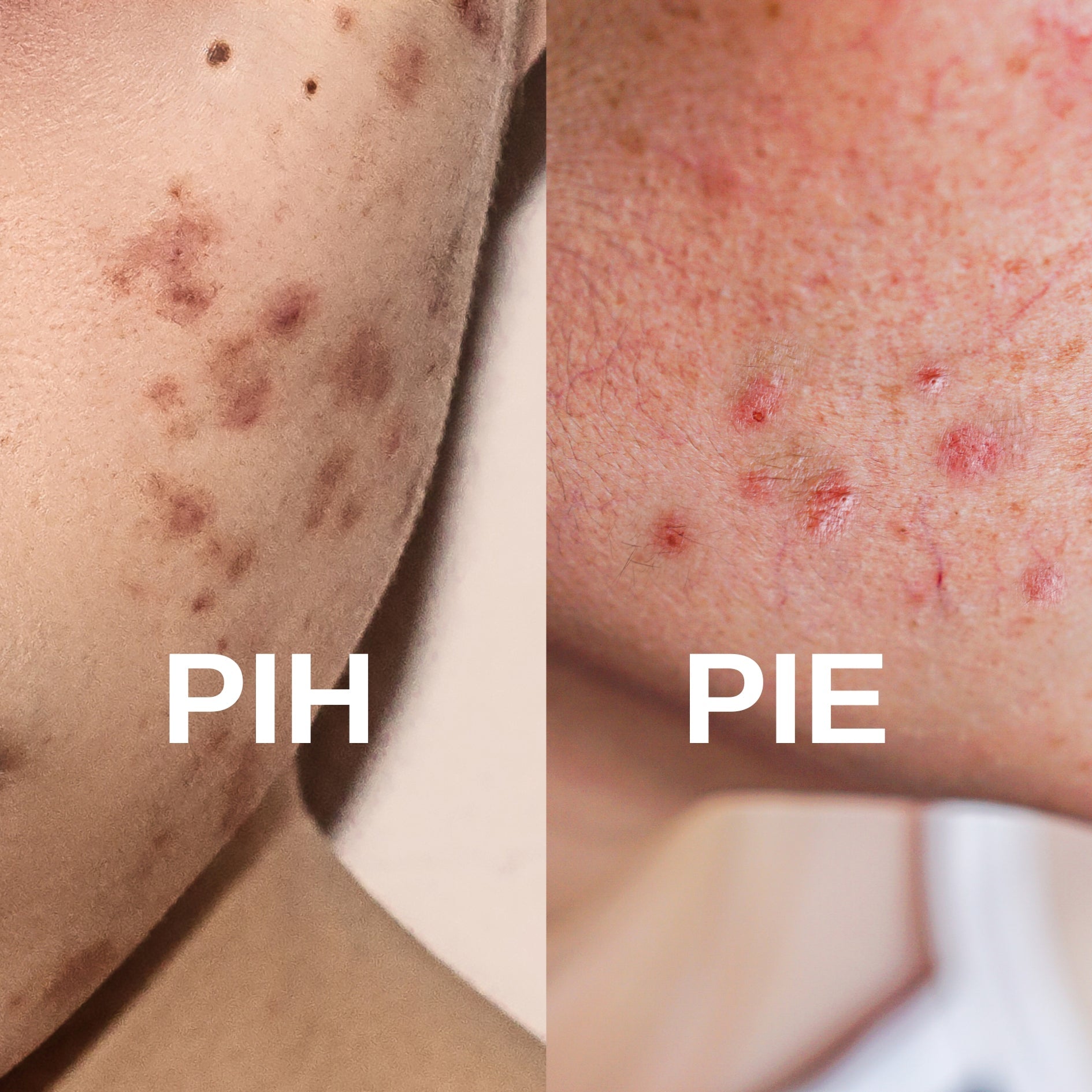 Removing Red Acne Scars