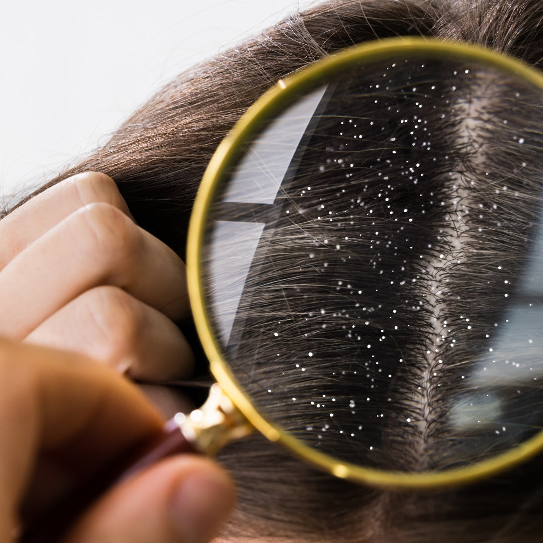 anti-dandruff shampoo and hair loss