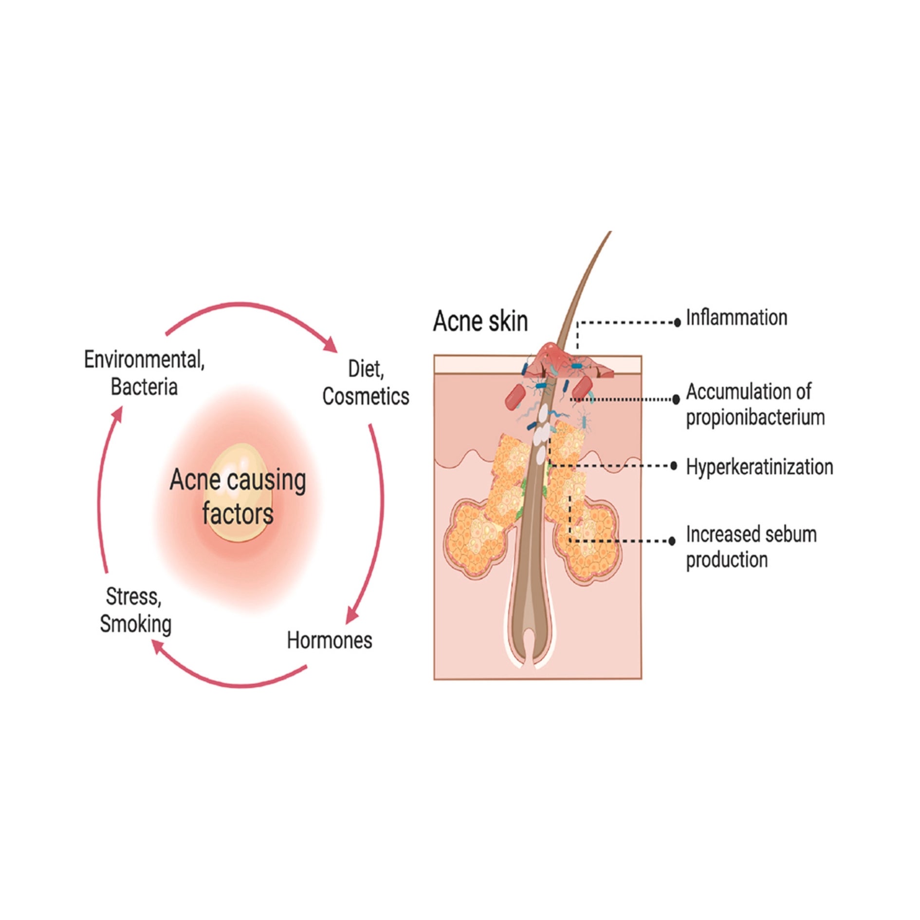 how to treat acne