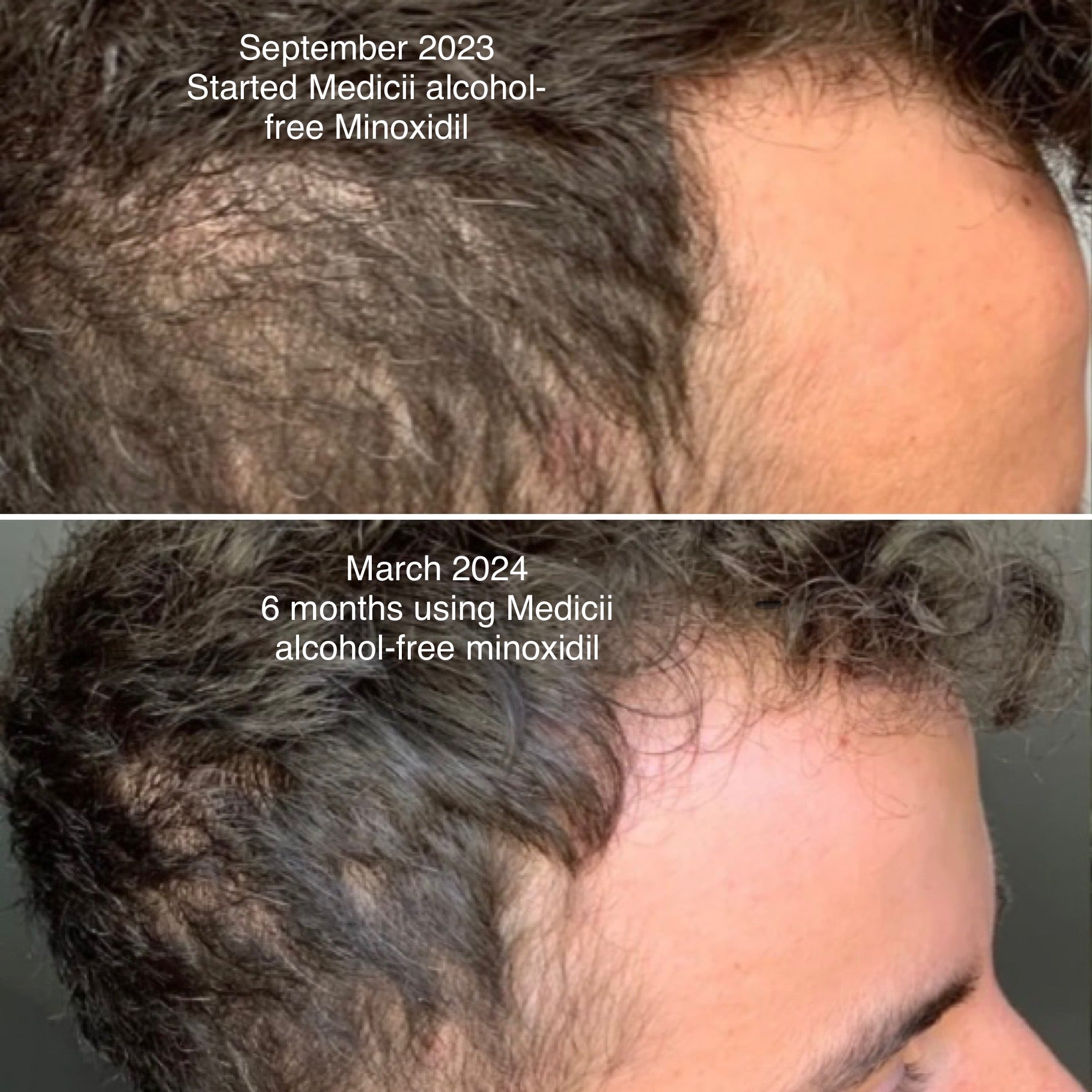 Minoxidil Plus+ (Alcohol-free | PG-free)